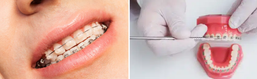 брекети самолігуючі ціна